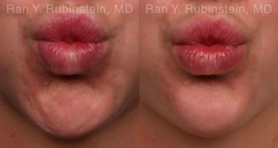 Botox Before and After Photos in Montvale, NJ, Patient 19853