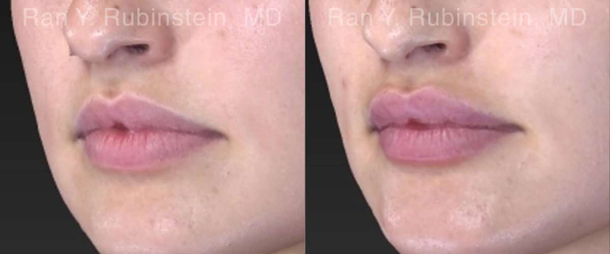 Lip Fillers Before and After Photos in Montvale, NJ, Patient 19857