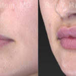 Lip Fillers Before and After Photos in Montvale, NJ, Patient 19857