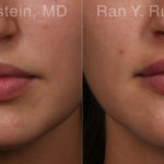 Lip Fillers Before and After Photos in Montvale, NJ, Patient 19857