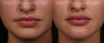 Lip Fillers Before and After Photos in Montvale, NJ, Patient 19857