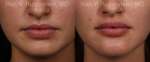 Lip Fillers Before and After Photos in Montvale, NJ, Patient 19857