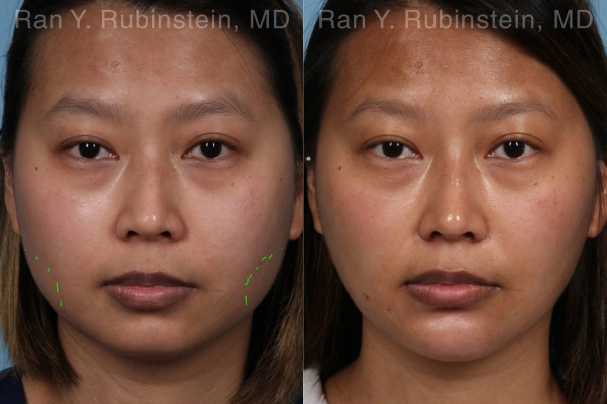 Botox Before and After Photos in Montvale, NJ, Patient 19957