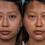 Botox Before and After Photos in Montvale, NJ, Patient 19957