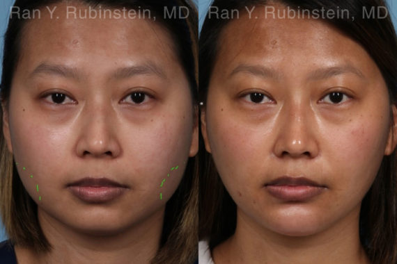 Botox Before and After Photos in Montvale, NJ, Patient 19957
