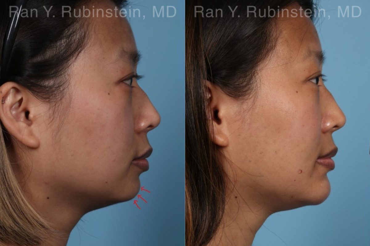 Chin Filler Before and After Photos in Montvale, NJ, Patient 19961