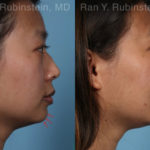 Chin Filler Before and After Photos in Montvale, NJ, Patient 19961