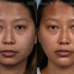 Chin Filler Before and After Photos in Montvale, NJ, Patient 19961