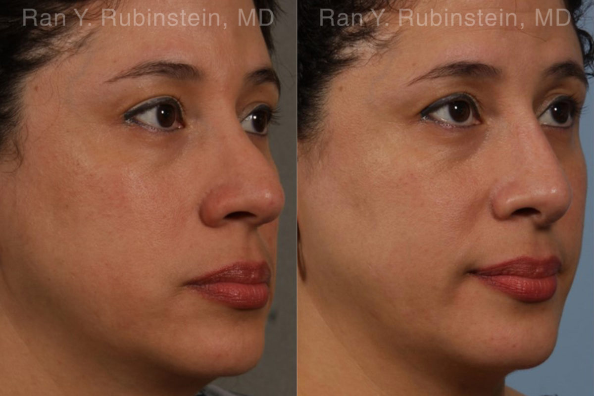 Revision Rhinoplasty Before and After Photos in Montvale, NJ, Patient 20011