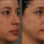 Revision Rhinoplasty Before and After Photos in Montvale, NJ, Patient 20011