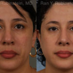 Revision Rhinoplasty Before and After Photos in Montvale, NJ, Patient 20011
