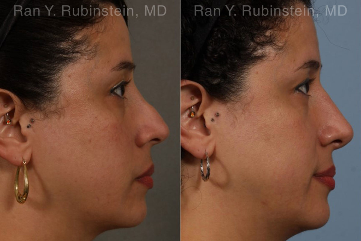 Revision Rhinoplasty Before and After Photos in Montvale, NJ, Patient 20011