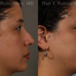 Revision Rhinoplasty Before and After Photos in Montvale, NJ, Patient 20011