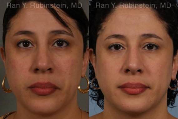 Revision Rhinoplasty Before and After Photos in Montvale, NJ, Patient 20011