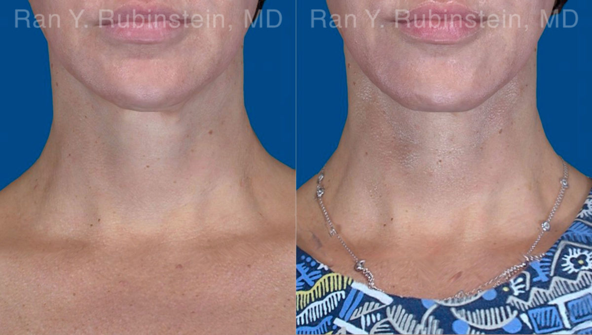 Face lift & Neck lift Before and After Photos in Montvale, NJ, Patient 20068