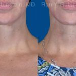 Face lift & Neck lift Before and After Photos in Montvale, NJ, Patient 20068