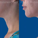 Face lift & Neck lift Before and After Photos in Montvale, NJ, Patient 20068