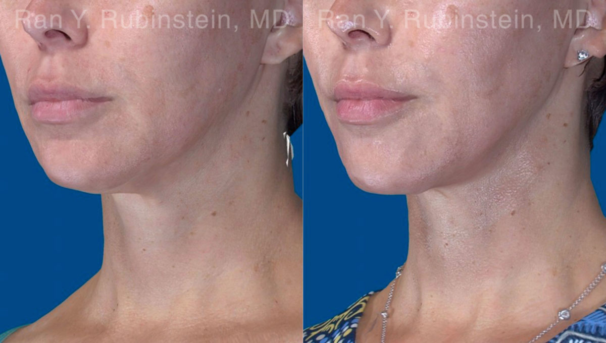 Face lift & Neck lift Before and After Photos in Montvale, NJ, Patient 20068