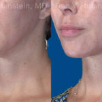 Face lift & Neck lift Before and After Photos in Montvale, NJ, Patient 20068