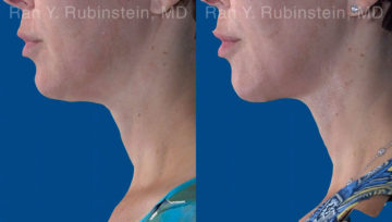 Face lift & Neck lift Before and After Photos in Montvale, NJ, Patient 20068