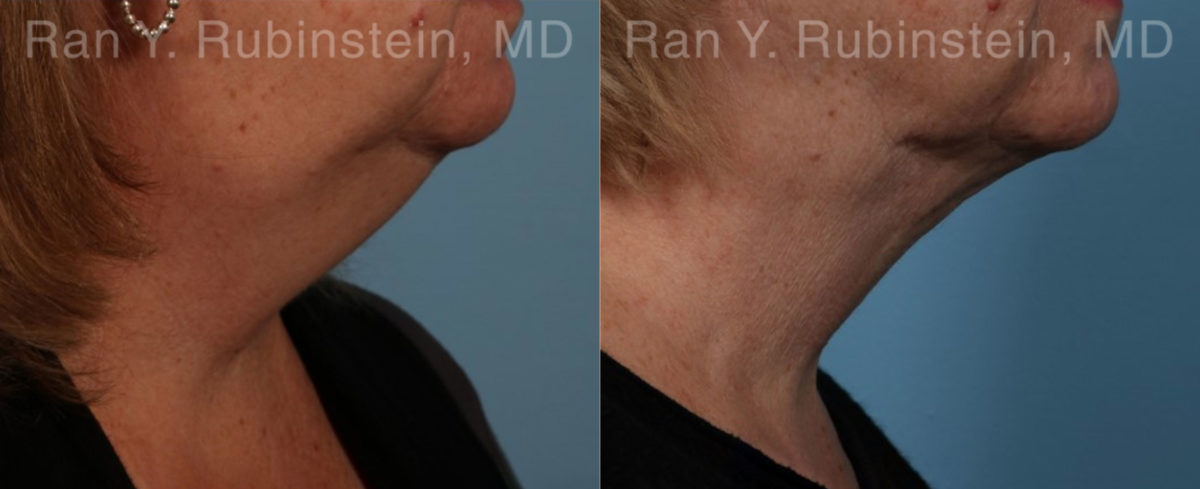 Laser Lift Precision Tx Before and After Photos in Montvale, NJ, Patient 20445
