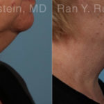 Laser Lift Precision Tx Before and After Photos in Montvale, NJ, Patient 20445