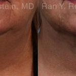Laser Lift Precision Tx Before and After Photos in Montvale, NJ, Patient 20445