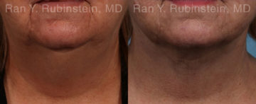 Laser Lift Precision Tx Before and After Photos in Montvale, NJ, Patient 20445