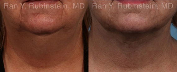 Laser Lift Precision Tx Before and After Photos in Montvale, NJ, Patient 20445