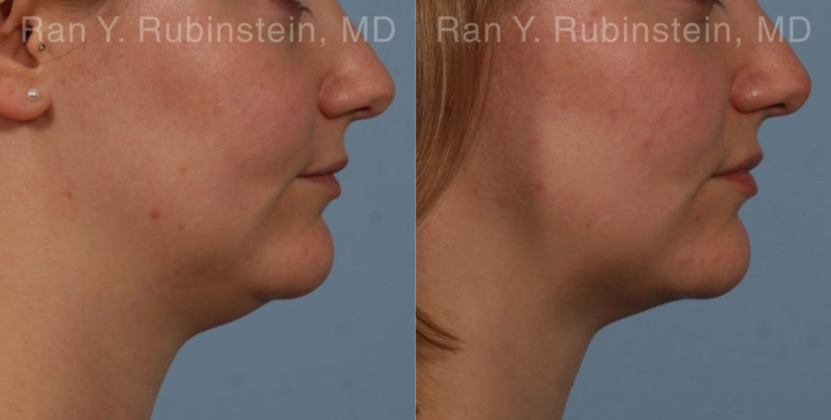 Laser Lift Precision Tx Before and After Photos in Montvale, NJ, Patient 20452