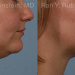 Laser Lift Precision Tx Before and After Photos in Montvale, NJ, Patient 20452