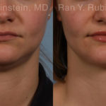 Laser Lift Precision Tx Before and After Photos in Montvale, NJ, Patient 20452