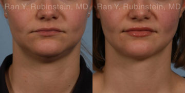 Laser Lift Precision Tx Before and After Photos in Montvale, NJ, Patient 20452