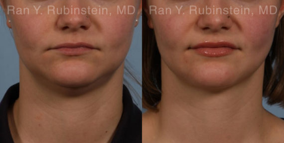 Laser Lift Precision Tx Before and After Photos in Montvale, NJ, Patient 20452