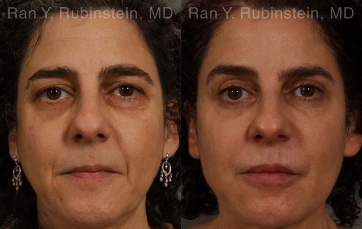 Eyelid Surgery Before and After Photos in Montvale, NJ, Patient 20475