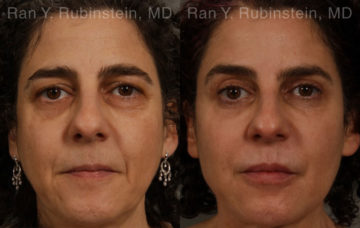 Eyelid Surgery Before and After Photos in Montvale, NJ, Patient 20475