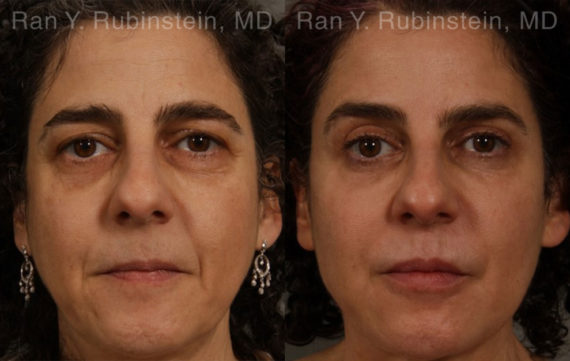 Eyelid Surgery Before and After Photos in Montvale, NJ, Patient 20475
