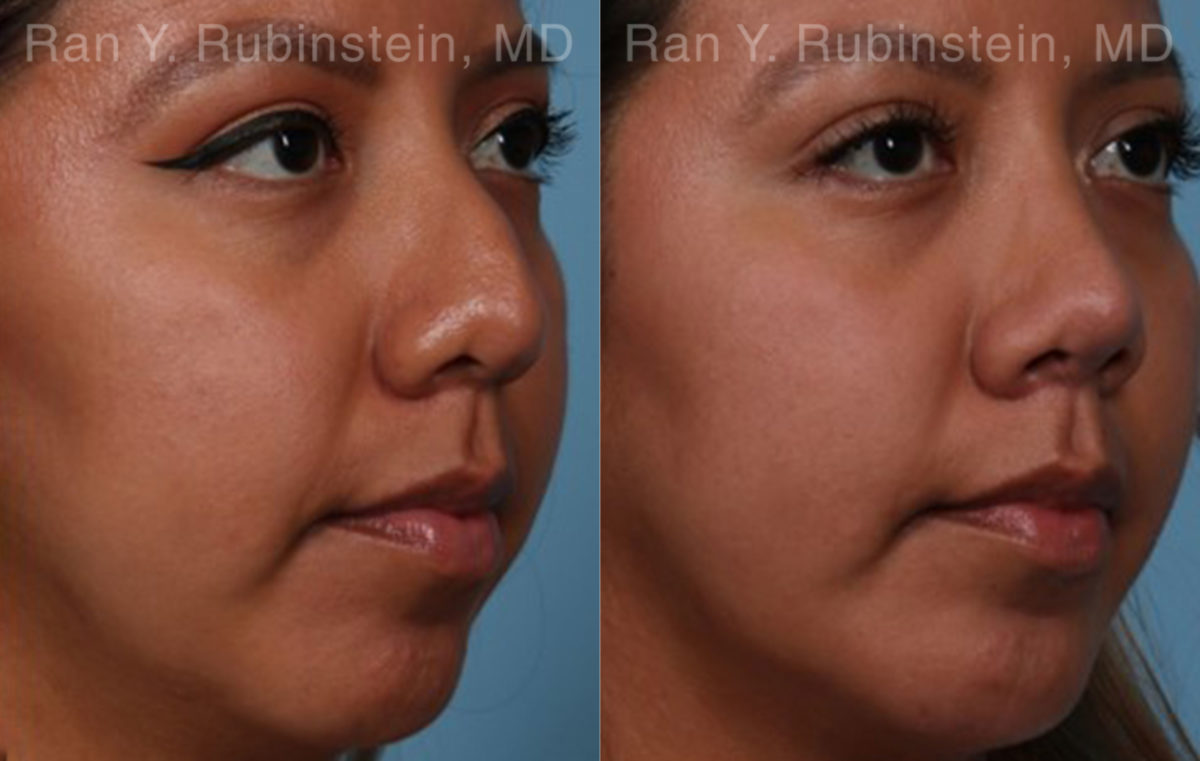 Ethnic Rhinoplasty Before and After Photos in Montvale, NJ, Patient 20479