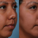Ethnic Rhinoplasty Before and After Photos in Montvale, NJ, Patient 20479