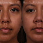 Ethnic Rhinoplasty Before and After Photos in Montvale, NJ, Patient 20479