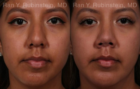 Ethnic Rhinoplasty Before and After Photos in Montvale, NJ, Patient 20479