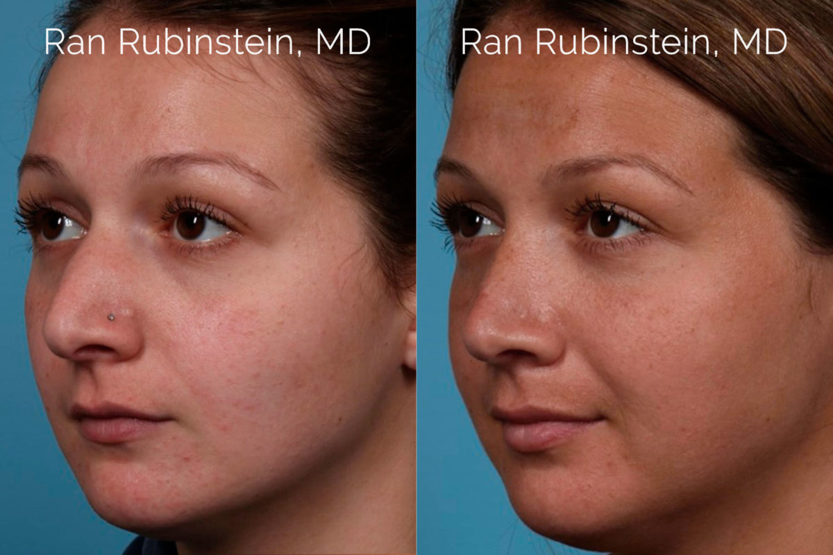 Rhinoplasty Before and After Photos in Montvale, NJ, Patient 20486