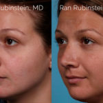 Rhinoplasty Before and After Photos in Montvale, NJ, Patient 20486