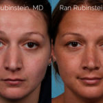 Rhinoplasty Before and After Photos in Montvale, NJ, Patient 20486