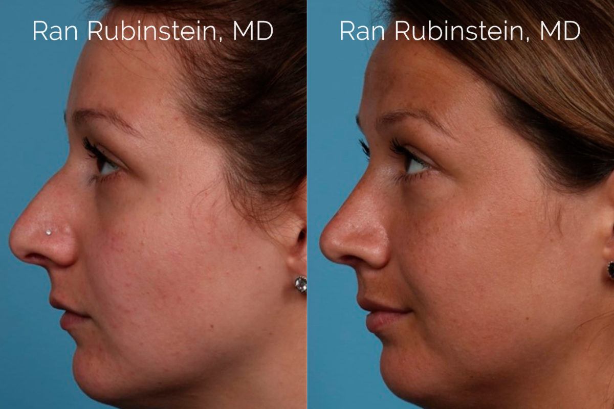 Rhinoplasty Before and After Photos in Montvale, NJ, Patient 20486