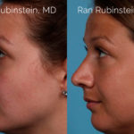 Rhinoplasty Before and After Photos in Montvale, NJ, Patient 20486
