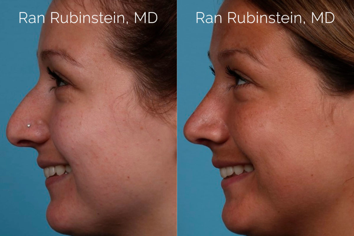 Rhinoplasty Before and After Photos in Montvale, NJ, Patient 20486