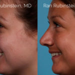 Rhinoplasty Before and After Photos in Montvale, NJ, Patient 20486