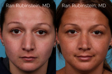 Rhinoplasty Before and After Photos in Montvale, NJ, Patient 20486