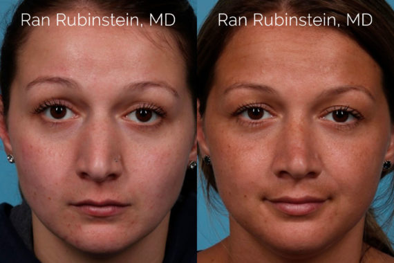 Rhinoplasty Before and After Photos in Montvale, NJ, Patient 20486